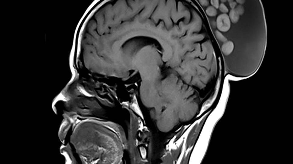 Zgłosiła się do lekarza z guzem. Miała go od dzieciństwa