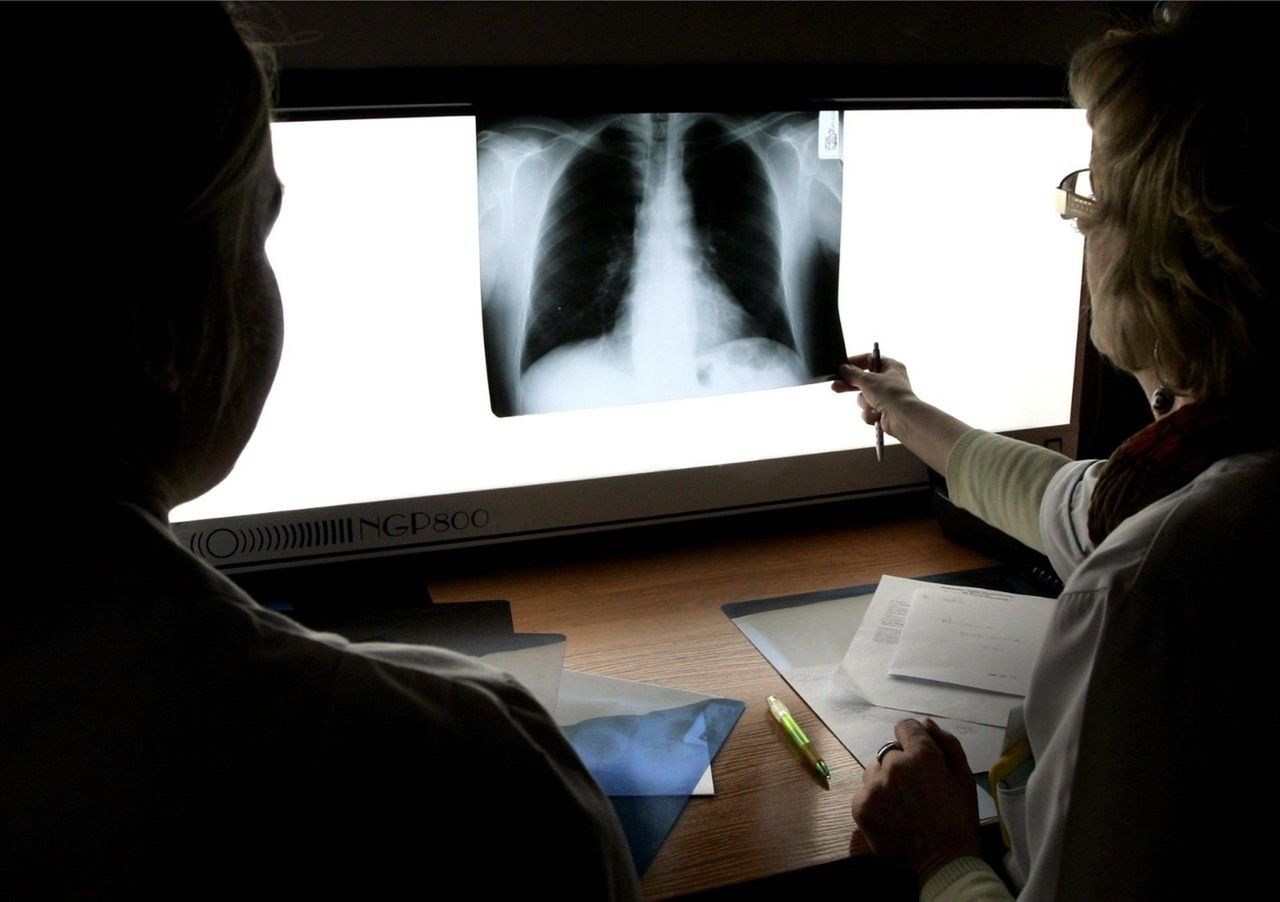 Rak płuc atakuje podstępnie. Sprawdź wczesne objawy, które łatwo przeoczyć