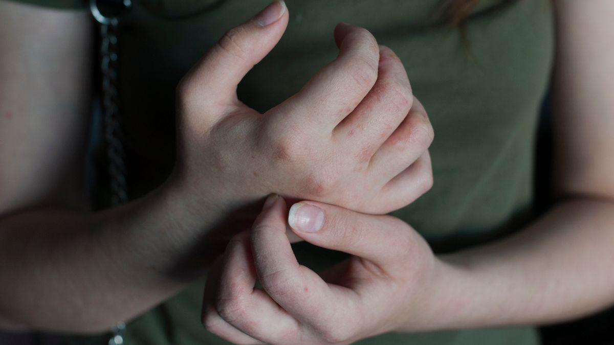 Plamica alergiczna – przyczyny, objawy, leczenie