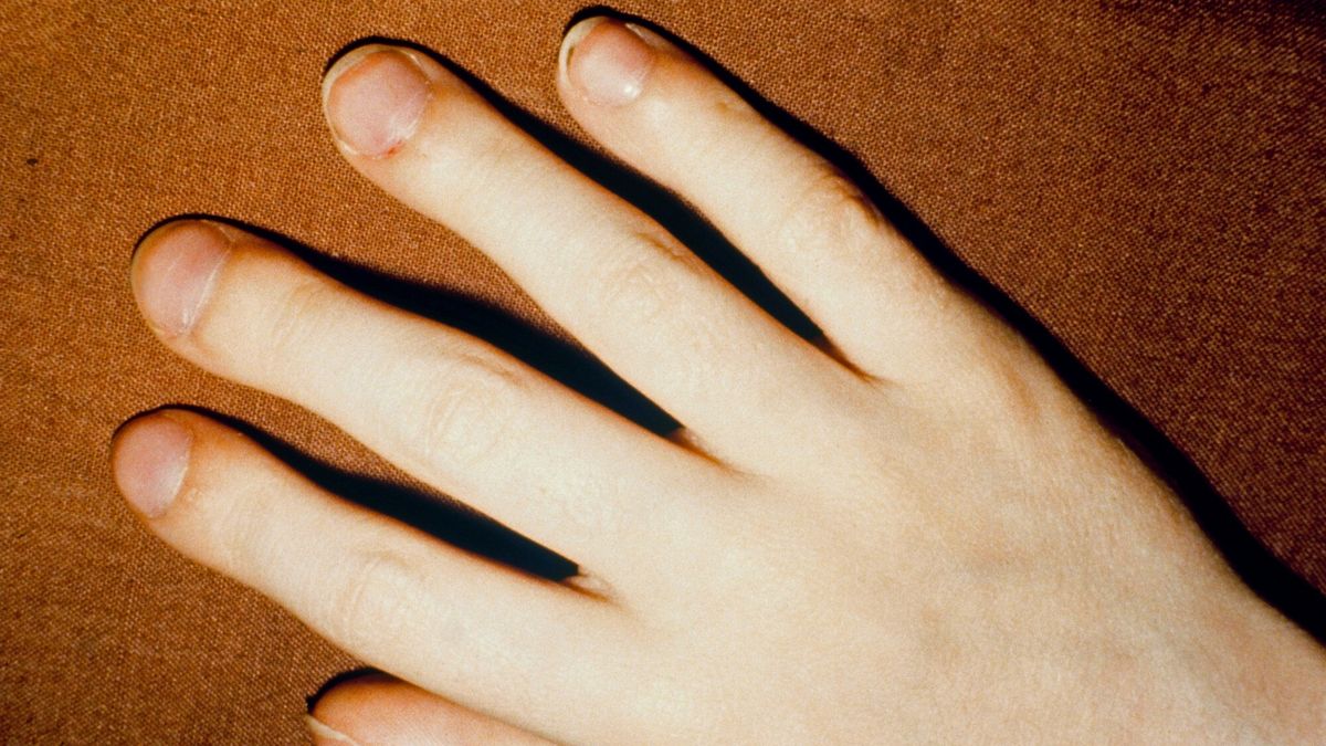 Kształt paznokci może być objawem groźnej choroby