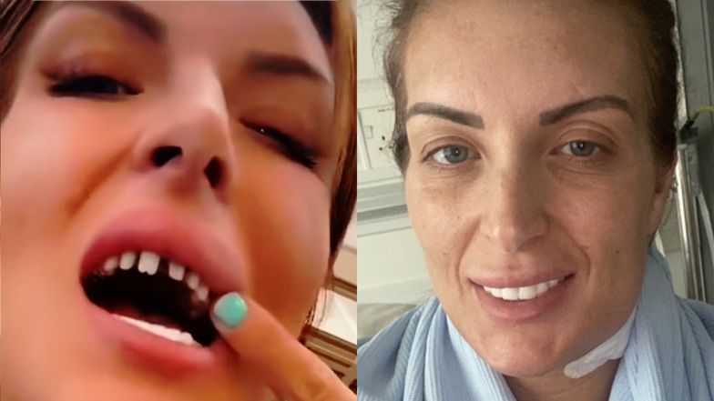 Zapłaciła tysiące za "tureckie zęby", skończyło się WALKĄ O ŻYCIE. Tiktokerka nie ukrywa, że przeżyła w klinice prawdziwy koszmar (FOTO)