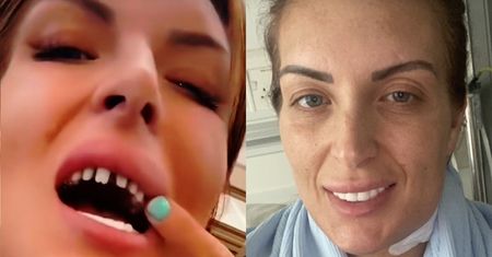 Zapłaciła tysiące za "tureckie zęby", skończyło się WALKĄ O ŻYCIE. Tiktokerka nie ukrywa, że przeżyła w klinice prawdziwy koszmar (FOTO)