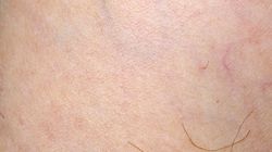 Teleangiektazje - przyczyny, objawy, leczenie