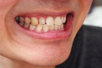 Masz żółte zęby? Dentysta wskazuje częsty błąd