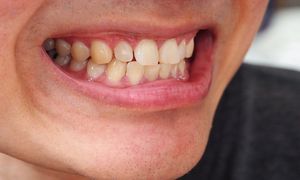 Masz żółte zęby? Dentysta wskazuje częsty błąd