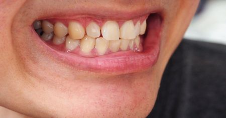 Zęby robią się żółte? Dentysta mówi, gdzie tkwi błąd