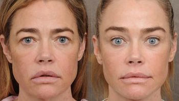 Denise Richards przeszła lifting twarzy. Lekarz pokazał efekt przemiany 55-latki. Robi wrażenie? (ZDJĘCIA)