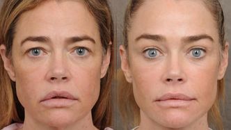 Denise Richards przeszła lifting twarzy. Lekarz pokazał efekt przemiany 55-latki. Robi wrażenie? (ZDJĘCIA)