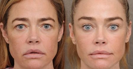 Denise Richards przeszła lifting twarzy. Lekarz pokazał efekt przemiany 55-latki. Robi wrażenie? (ZDJĘCIA)