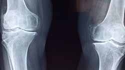 Osteoklasty - powstawanie, budowa i funkcje komórek kościogubnych