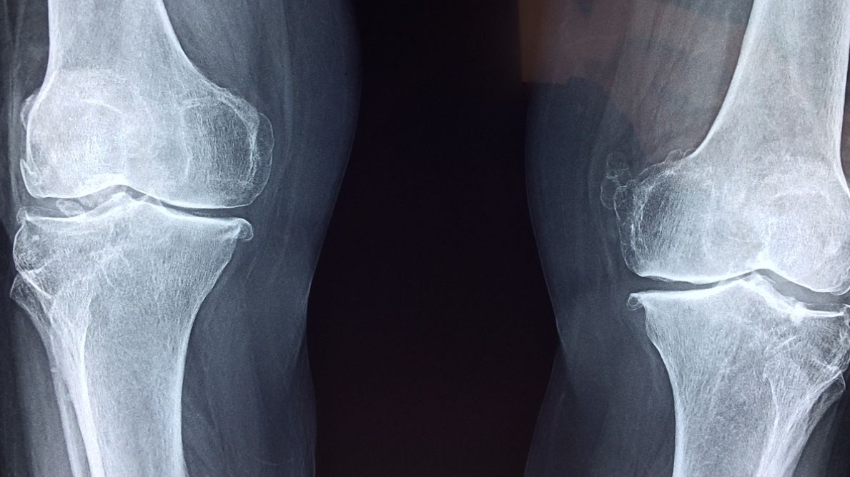 Podstawową funkcją osteoklastów jest resorpcja kości. To powolne wchłanianie składników mineralnych kości, które prowadzi do jej wymiany lub zaniku. W prawidłowo funkcjonującym organizmie jest to proces naturalny.