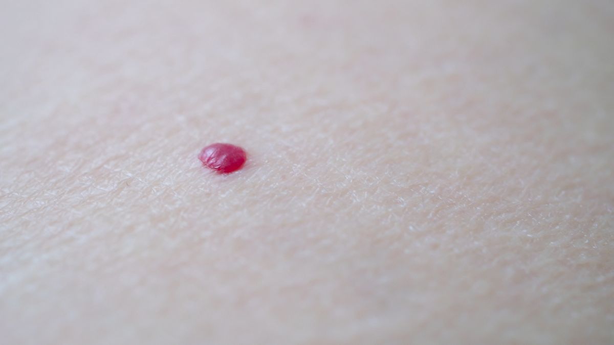 Red moles on skin, closeup
Healthcare/Medical
NoonVirachada