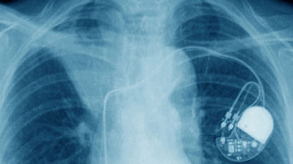 iPhone 12 może wyłączyć rozrusznik serca. Naukowcy ostrzegają 1