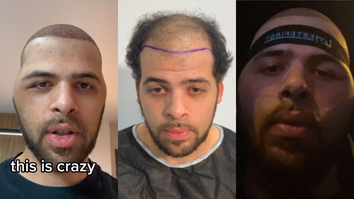 Przeszczepił włosy w Turcji. Pokazał, co działo się potem