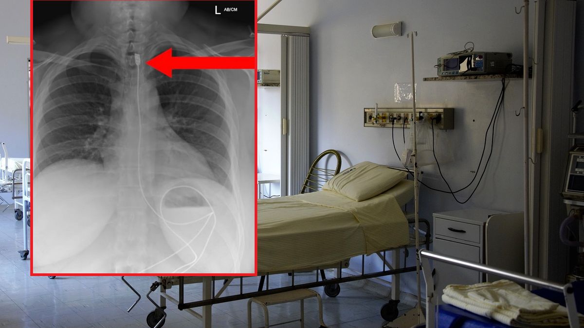 Kobieta połknęła kabel do ładowarki.