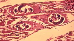 Włosień kręty - cykl rozwojowy, zakażenie i objawy włośnicy