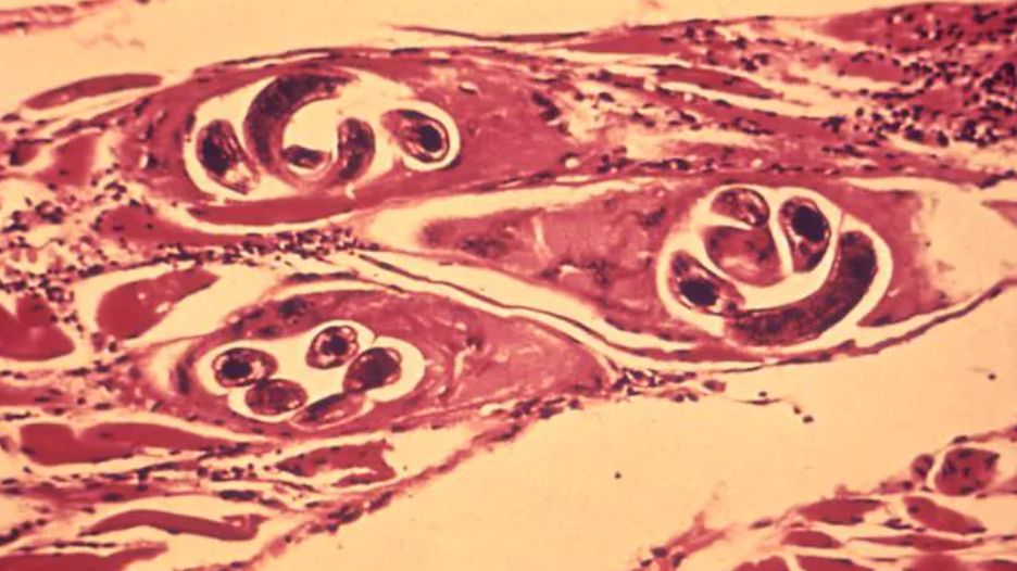 Włosień kręty jest z najgroźniejszych pasożytów człowieka. Wywołuje włośnicę, która może mieć nie tylko ciężki przebieg, ale i prowadzić do śmierci.