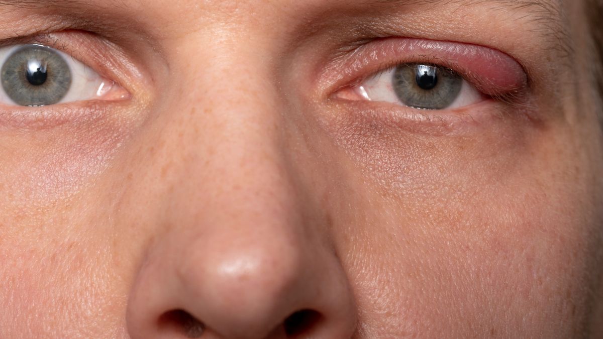 Zapchany gruczoł Meiboma może prowadzić do zapalenia brzegów powiek