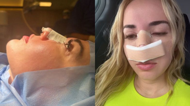 Marianna Schreiber przeszła korektę nosa