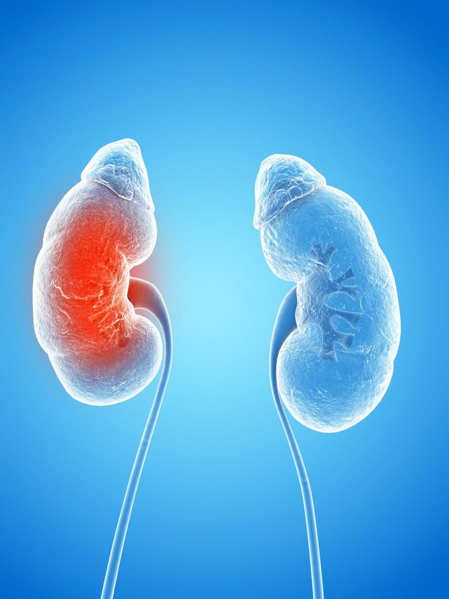 Ostre odmiedniczkowe zapalenie nerek może mieć wiele przyczyn