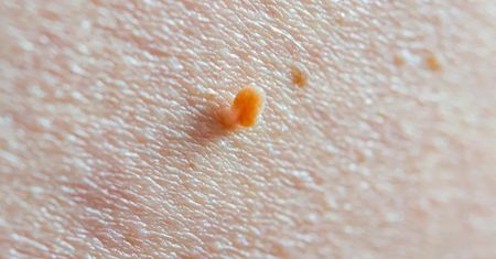 Widzisz je na skórze? Dermatolożka mówi, czego unikać