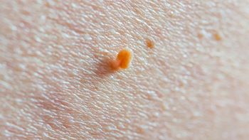 Masz takie zmiany? Dermatolożka ostrzega, czego nie robić