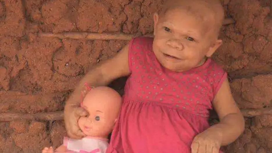 Na zawsze uwięziona w ciele niemowlaka. Maria Audete ma już 40 lat