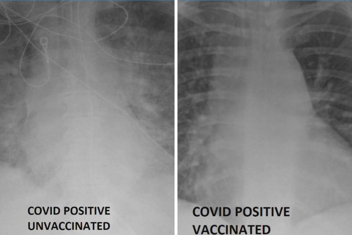 Lekarz ujawnia zdjęcia RTG pacjentów. Jak wyglądają płuca zaszczepionych na COVID-19?
