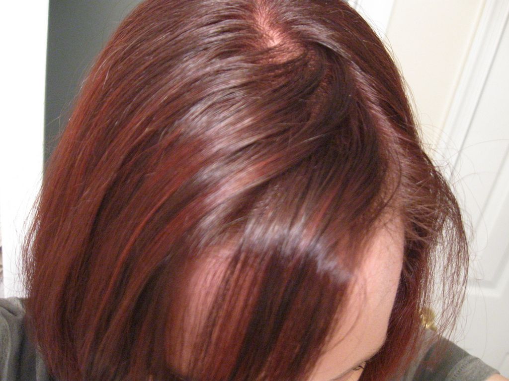 Łojotokowe zapalenie skóry głowy - przyczyny i objawy, leczenie