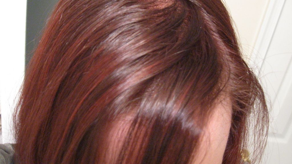 Łojotokowe zapalenie skóry głowy może być wywoływane zaburzeniami hormonalnymi 