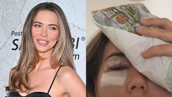 Obolała Sandra Kubicka nadaje z mrożonką na głowie PO OPERACJI POWIEK: "Jest dokładnie tak jak przypuszczałam..." (FOTO)