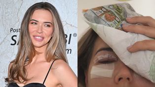 Obolała Sandra Kubicka nadaje z mrożonką na głowie PO OPERACJI POWIEK: "Jest dokładnie tak jak przypuszczałam..." (FOTO)