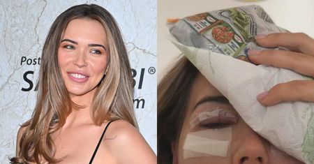 Obolała Sandra Kubicka nadaje z mrożonką na głowie PO OPERACJI POWIEK: "Jest dokładnie tak, jak przypuszczałam..." (FOTO)
