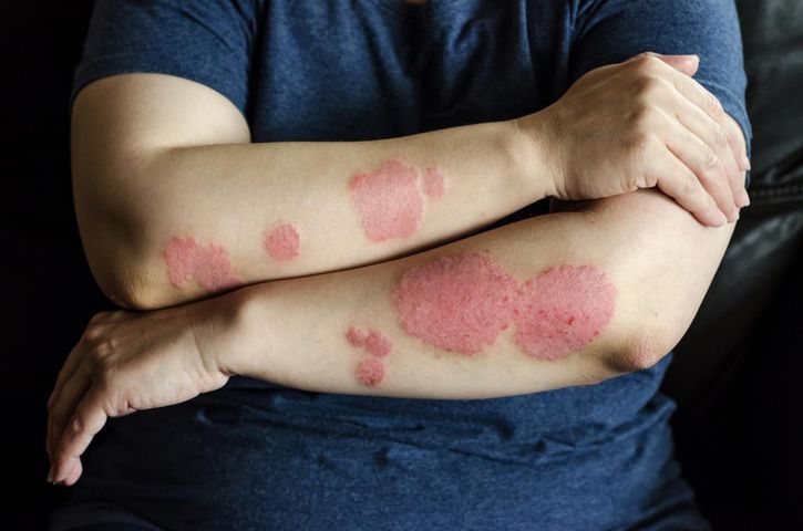Zespół Sweeta, inaczej ostra gorączkowa dermatoza neutrofilowa, jest rzadką chorobą skóry.