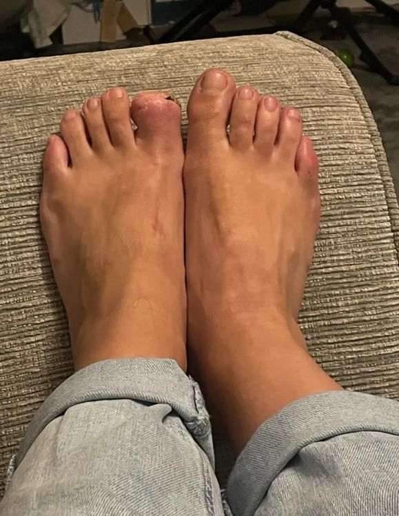 Blizna przypomina 40-latce, by nie bagatelizować niepokojących objawów