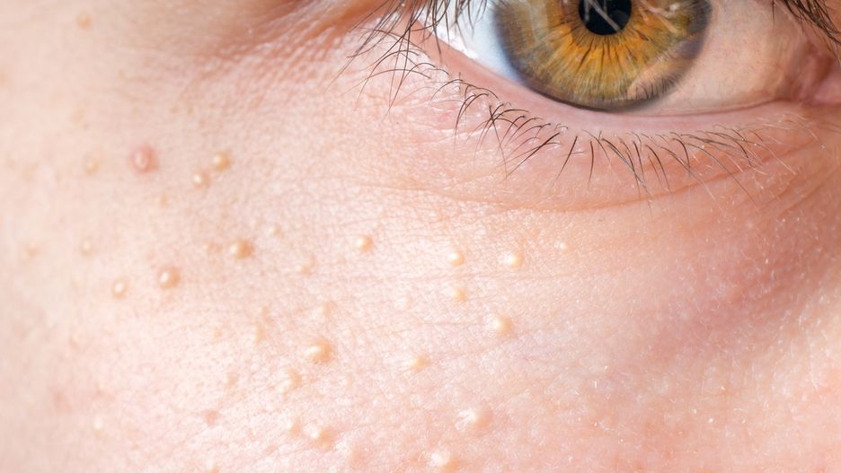 Kaszaki wyglądają nieestetycznie