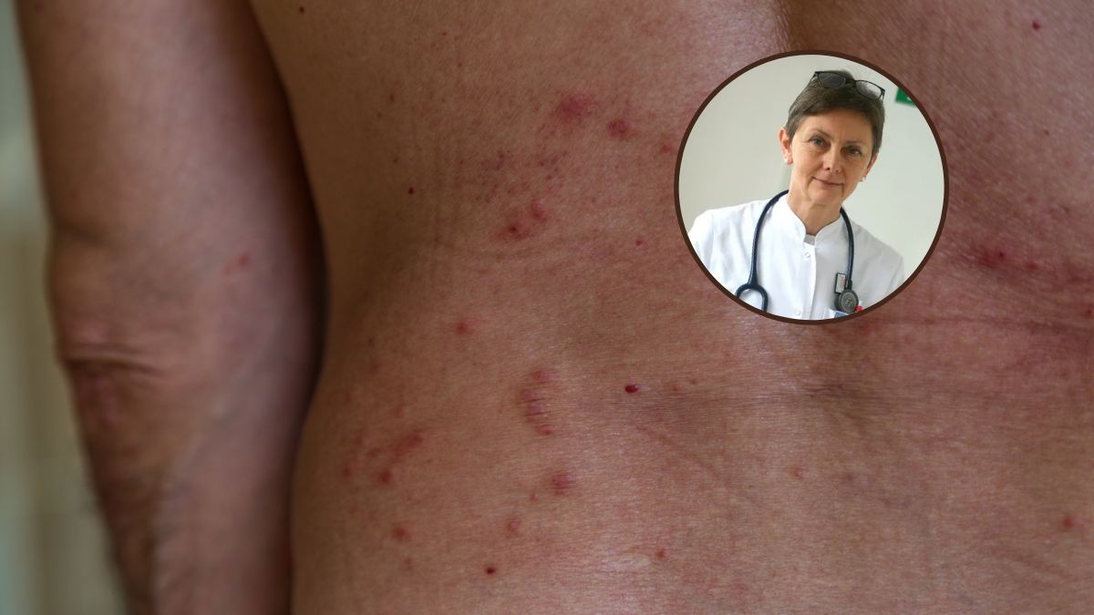 Półpaśca wywołuje ten sam wirus, który odpowiada za ospę wietrzną