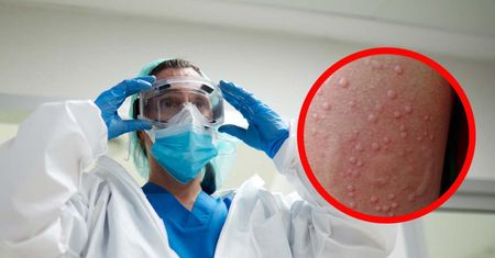 Wirus mpox w Niemczech. Wykryto pierwszy przypadek nowego wariantu