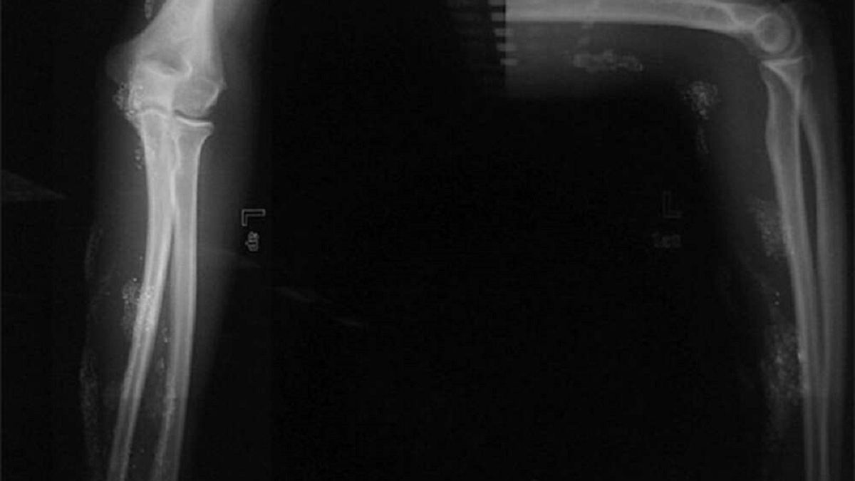 Nastoletni chłopiec wstrzyknął sobie rtęć, aby zostać X-manem 