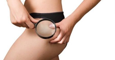 Jak pozbyć się cellulitu? List do Dermatologa