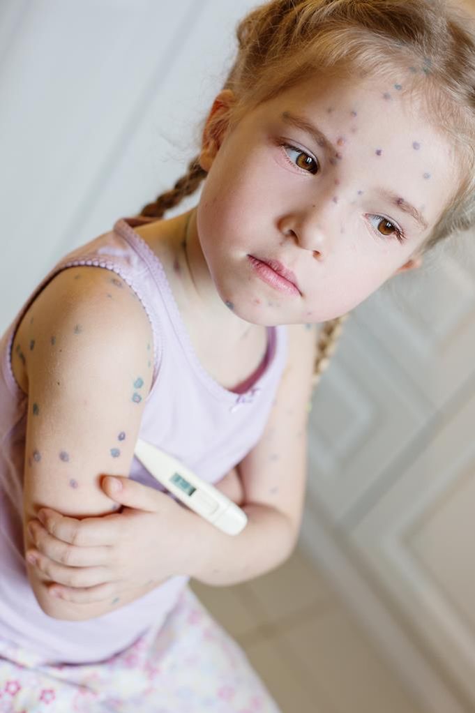 Wysypka na brzuchu może być objawem szkarlatyny, różyczki, ospy alub odry.