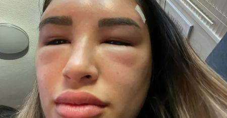 Lifting brwi. Chciała być jak Bella Hadid. Po zabiegu wyglądała, jakby miała rogi