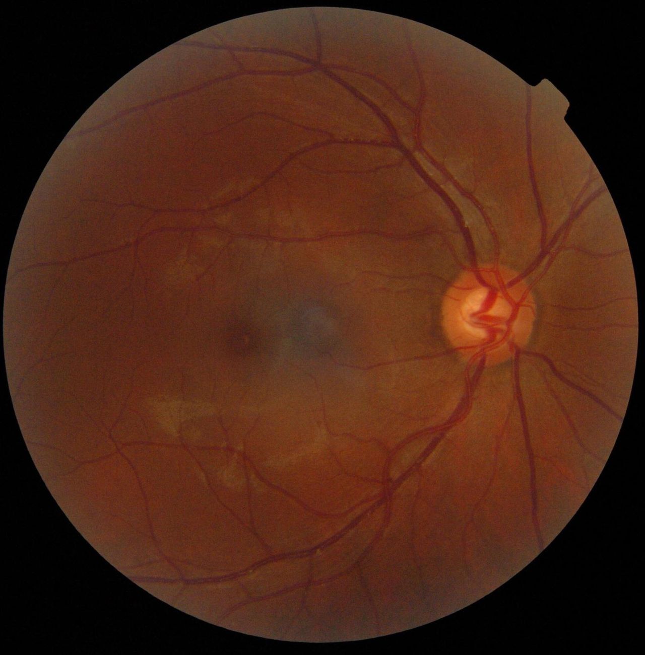 Tarcza nerwu wzrokowego pozbawiona jest fotoreceptorów