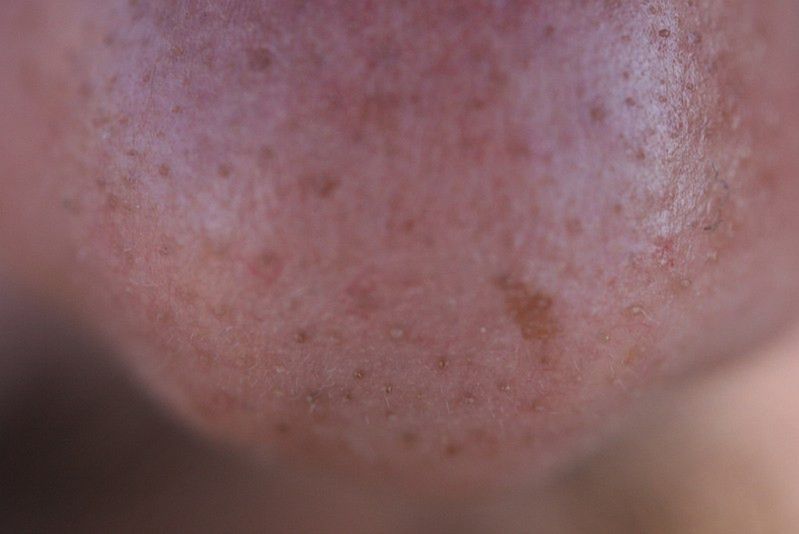 Rak skóry - nieregularny kształt 