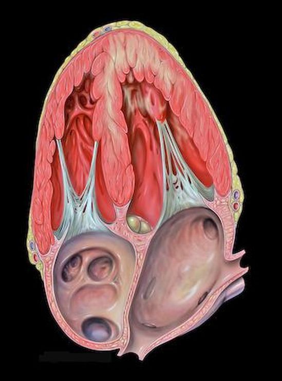 Atlas anatomiczny - serce z dysfunkcją przedniej ściany 