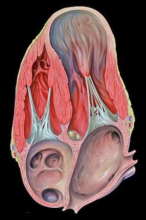 Atlas anatomiczny - tętniak lewej komory serca 