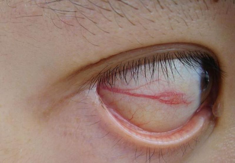Choroby oczu - owrzodzenie rogówki 