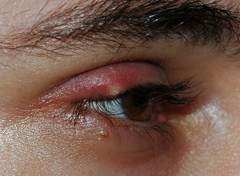 Choroby oczu - jęczmień na oku 