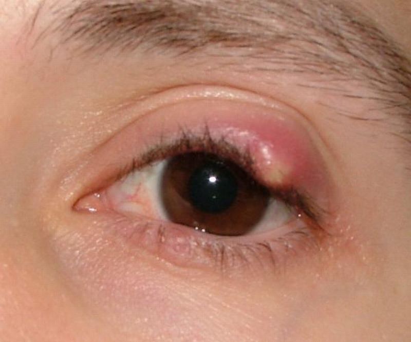 Choroby oczu - gradówka na oku 