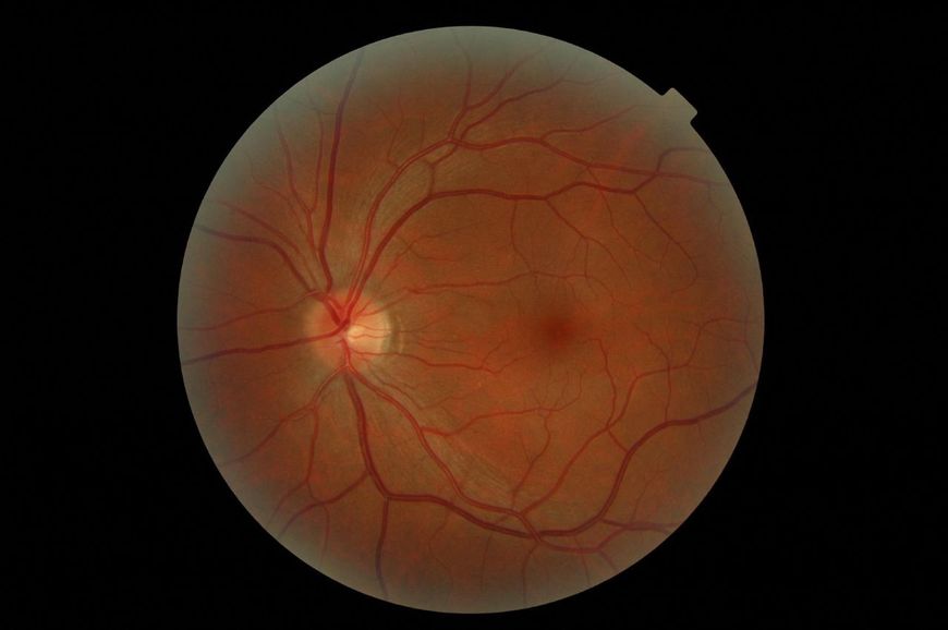 Choroby oczu - obraz gałki ocznej 
